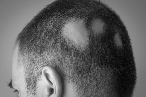 Alopecia-Treatment-Melbourne-Tile_03