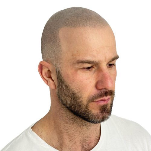 Scalp Micropigmentation Melbourne - Bald Look