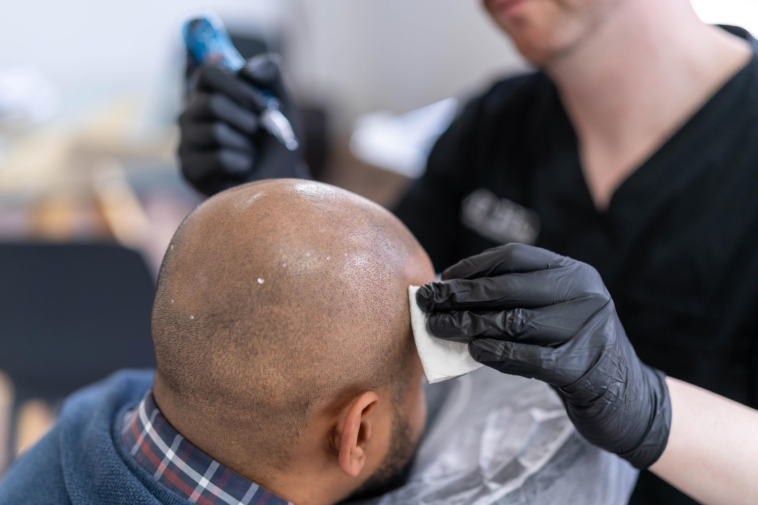 Scalp Micropigmentation Repair: Correcting Imperfections for a Natural Look