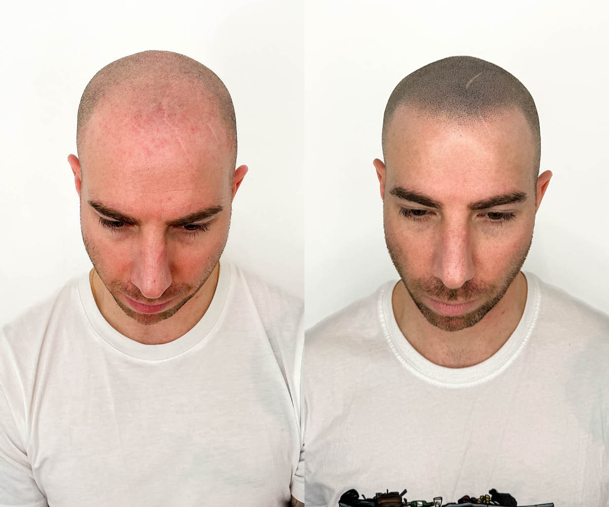 Scalp micropigmentation before and after - SMP HQ