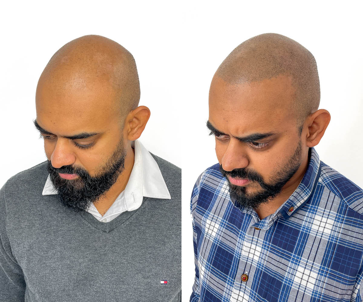 Scalp micropigmentation before and after - SMP HQ