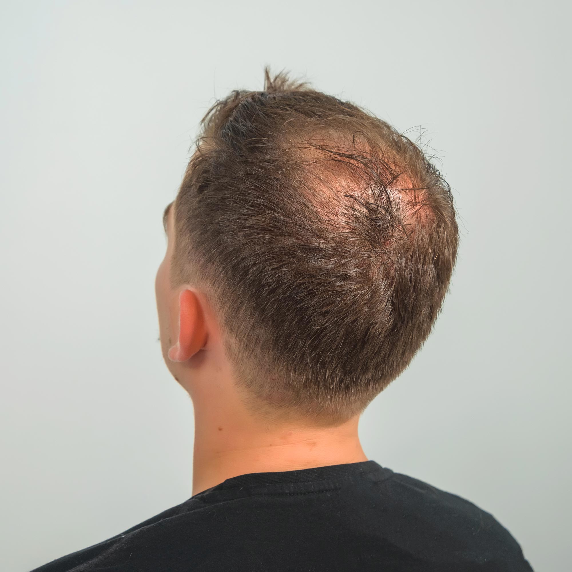 Thinning hair loss solutions Melbourne