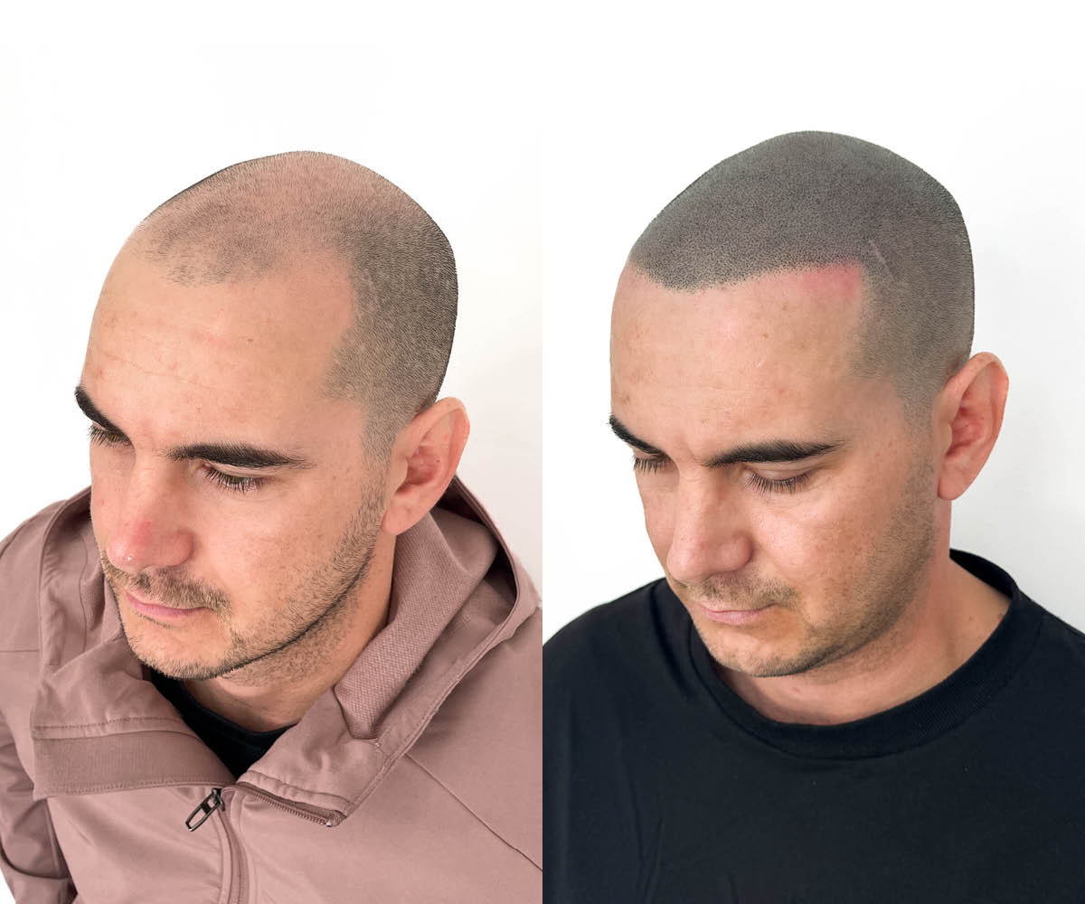 Male pattern baldness case study - SMP HQ