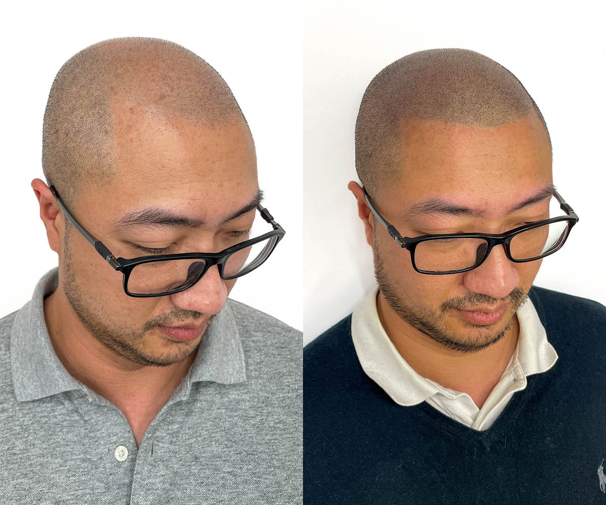 Male pattern baldness case study - SMP HQ
