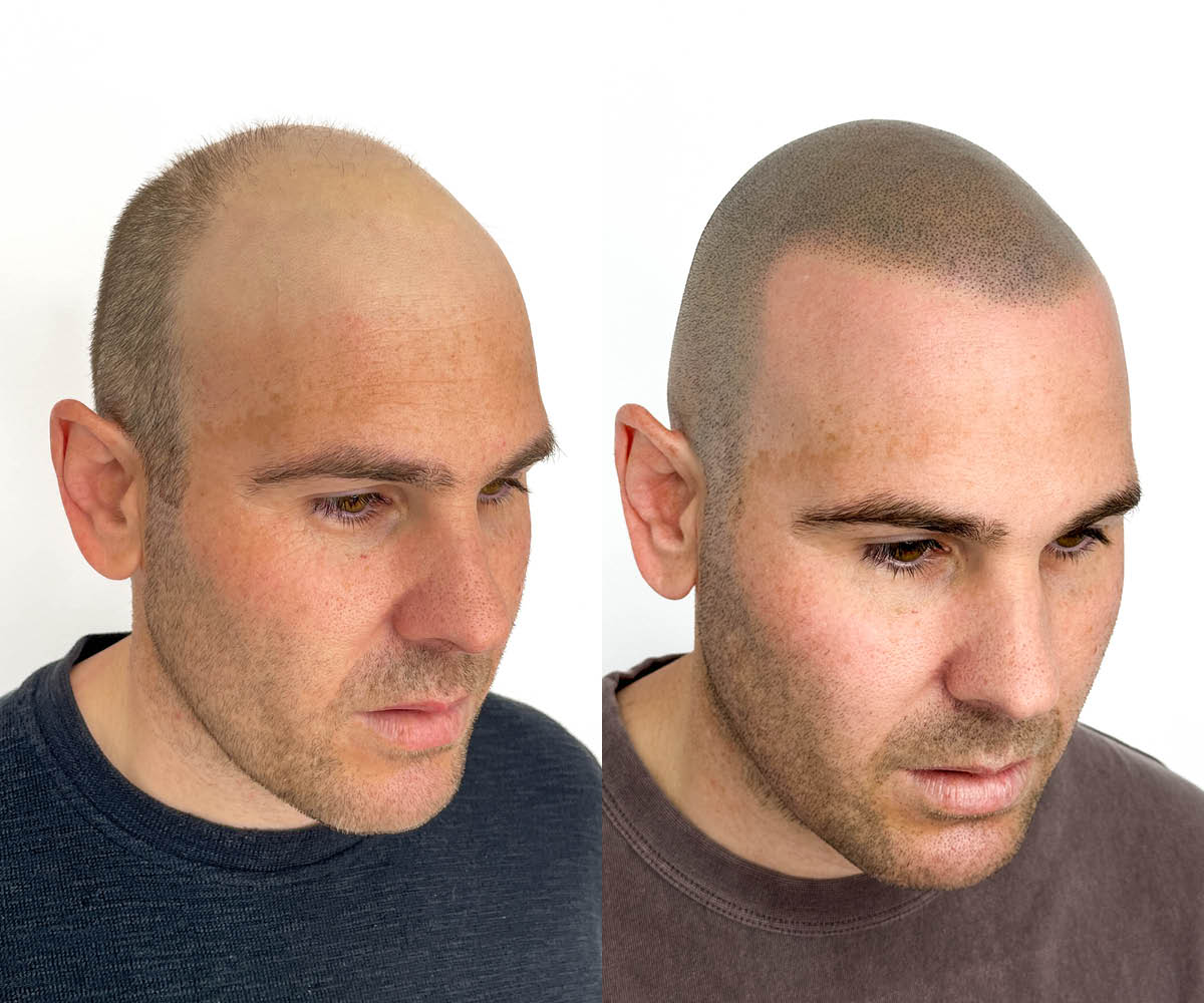 Male pattern baldness case study - SMP HQ