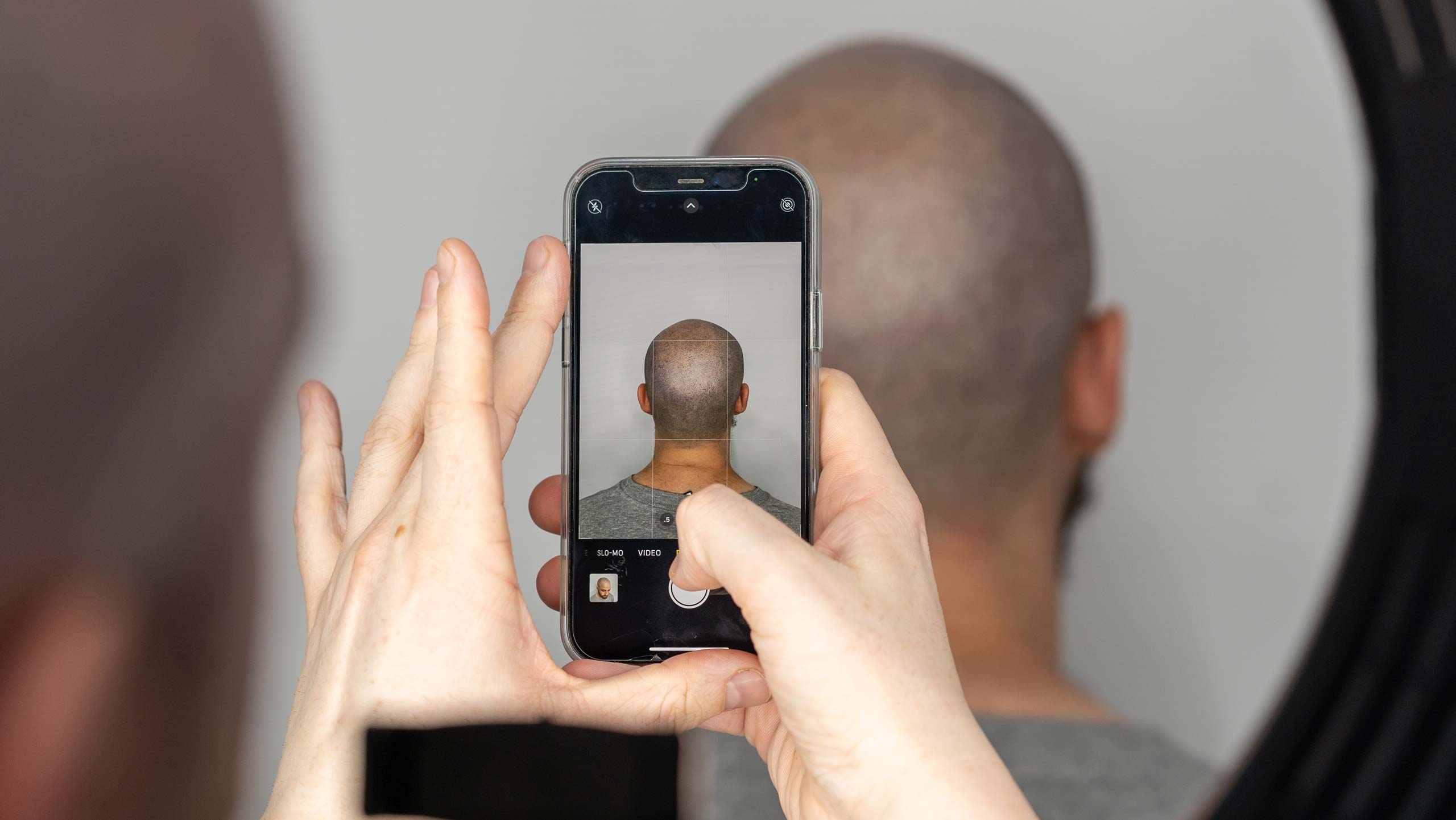 Do You Have To Shave Your Head For Scalp Micropigmentation?