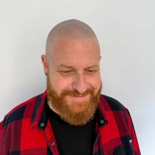 Hair tattoo treatments Melbourne hairline restoration - SMP HQ