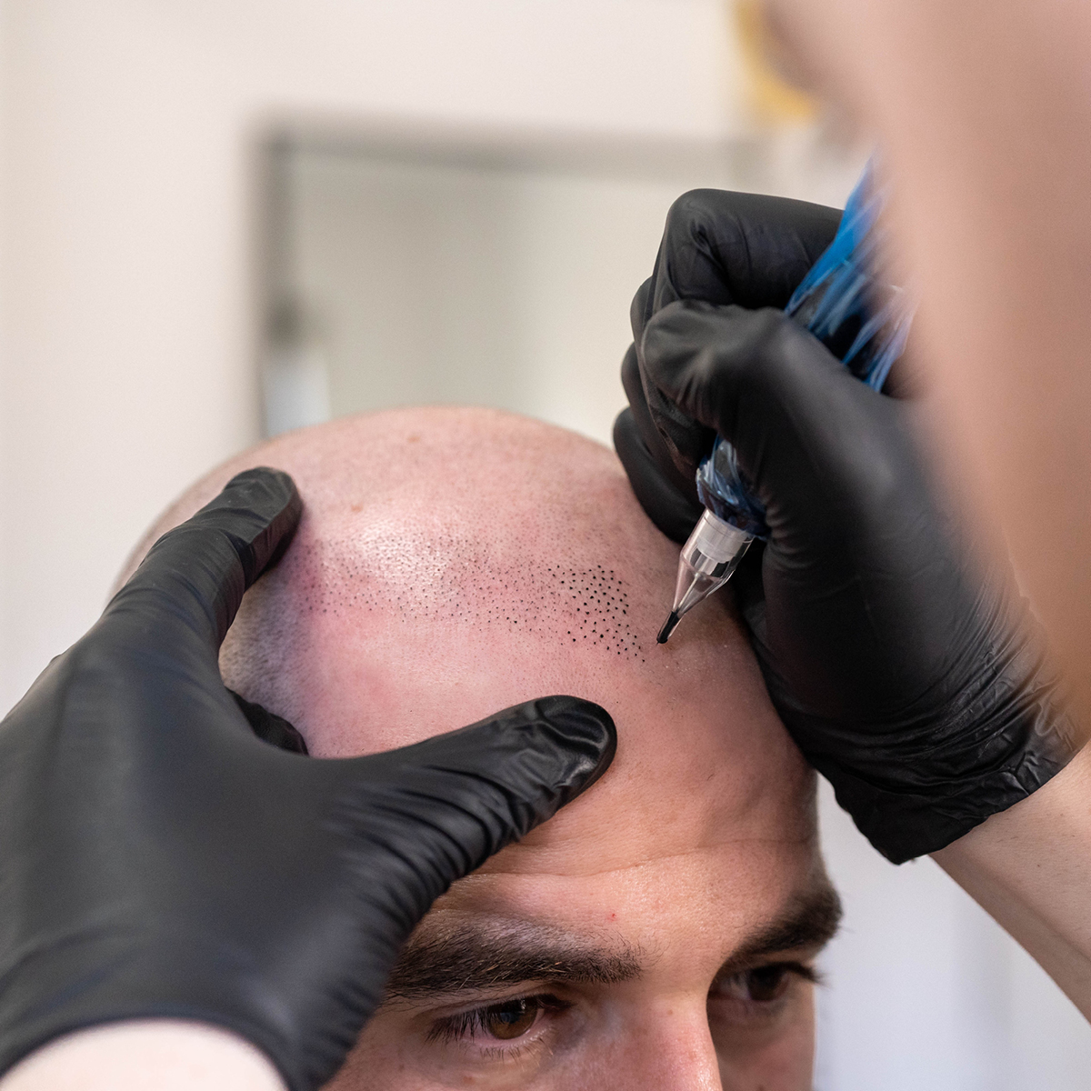 Scalp micropigmentation example of dots in Melbourne | SMP HQ