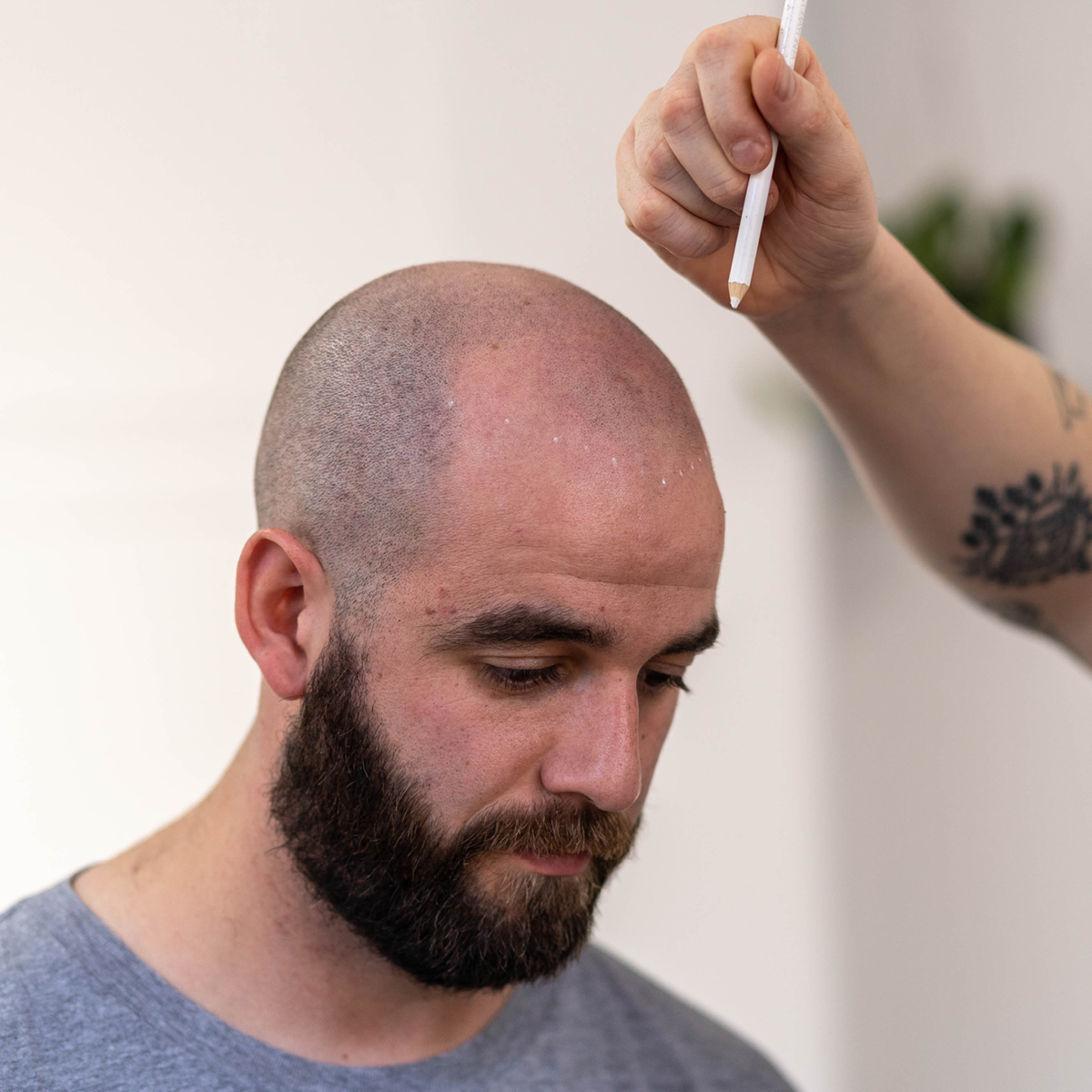 Hairline drawing for scalp micropigmentation in Melbourne | SMP HQ